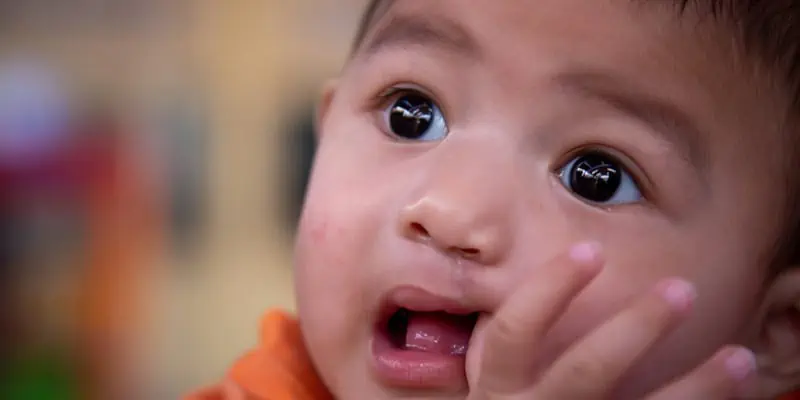 Narith After His First Surgery To Repair His Cleft Lip